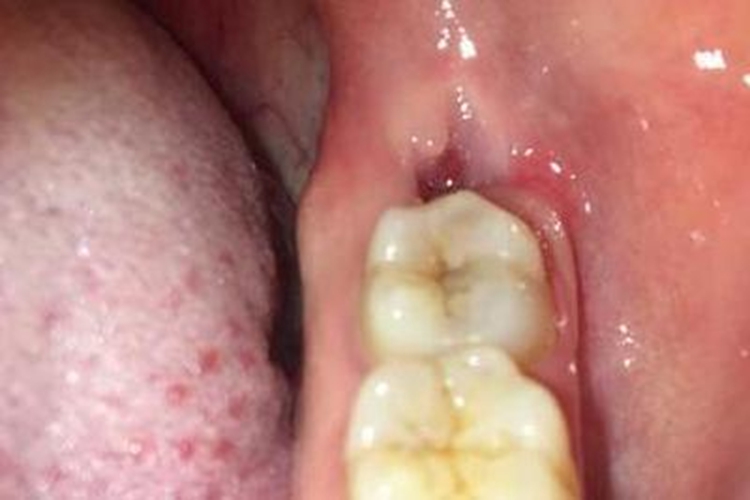 拔智齿后长肉芽组织图