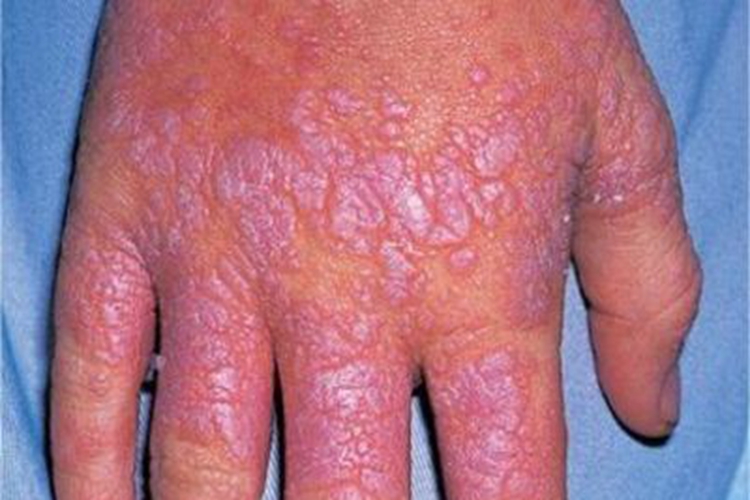 扁平苔藓样药疹丘疹图