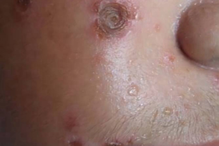 脓窝疮面部有坑和结痂图