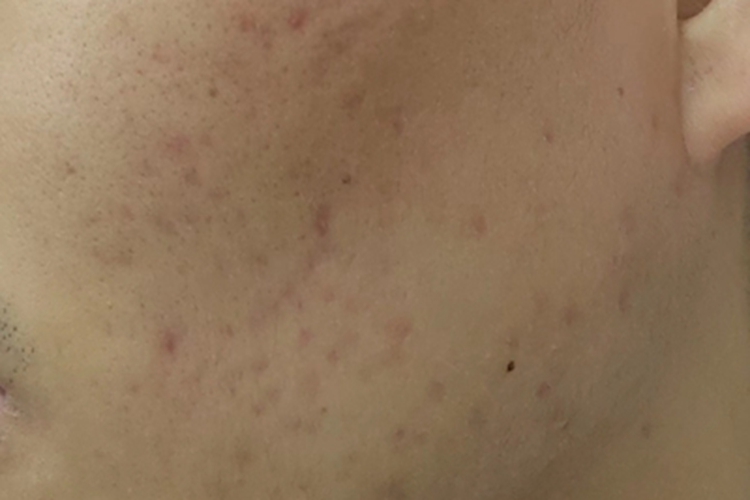 萎缩性瘢痕面部瘢痕图