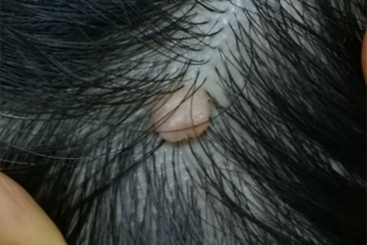 软纤维瘤头皮症状图