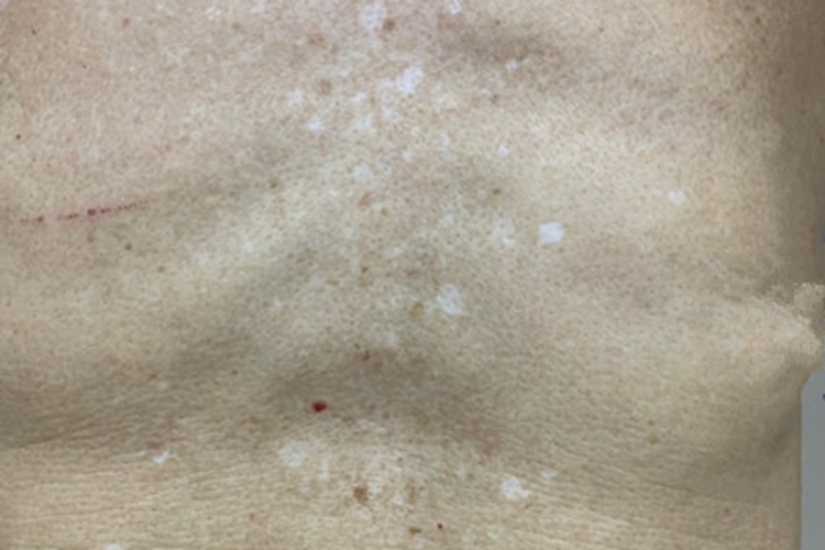 老年性白斑胸部症状图