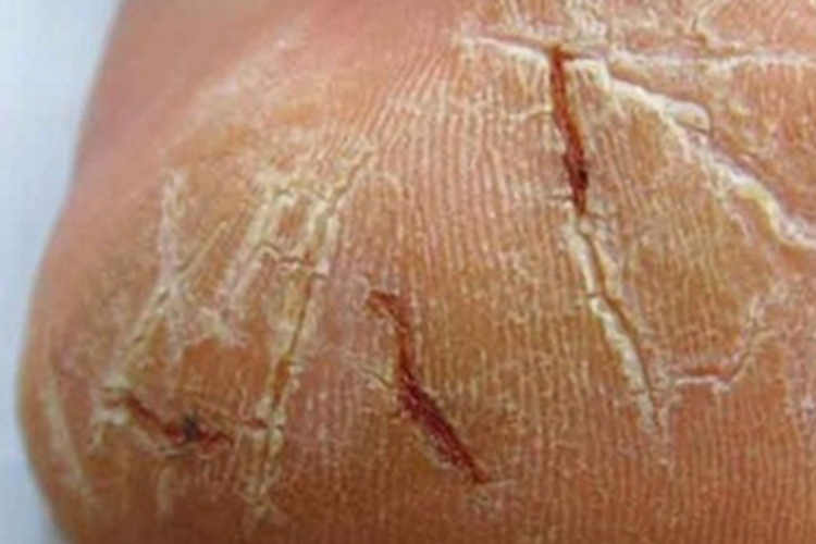 手足皲裂脚后跟症状图