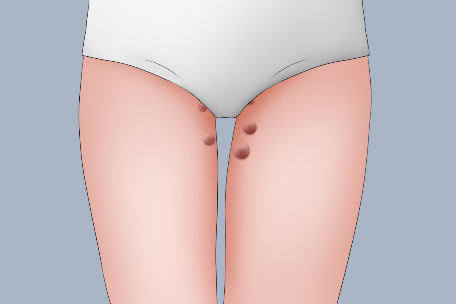 大腿根部纤维肉瘤 大腿根部纤维肉瘤