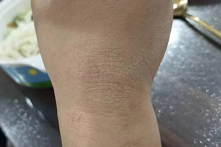 干性湿疹手腕皮肤粗糙图 干性湿疹手腕皮肤粗糙图