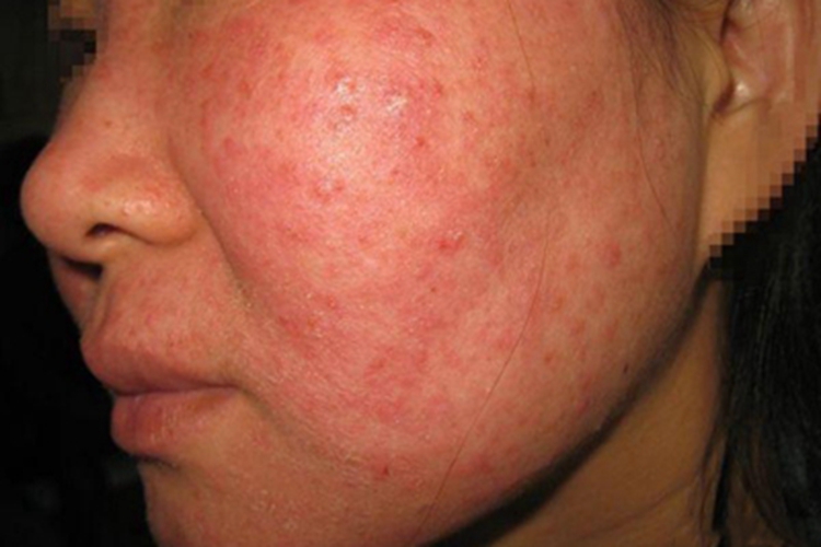螨虫皮炎面部红斑图 螨虫皮炎面部红斑图