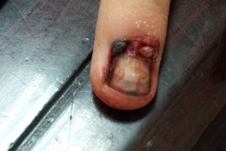 夹伤手指甲症状图