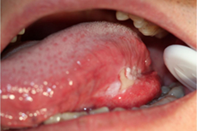 舌癌舌侧肿块表面糜烂图