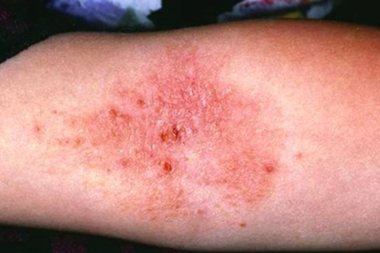 难辨认癣结痂图