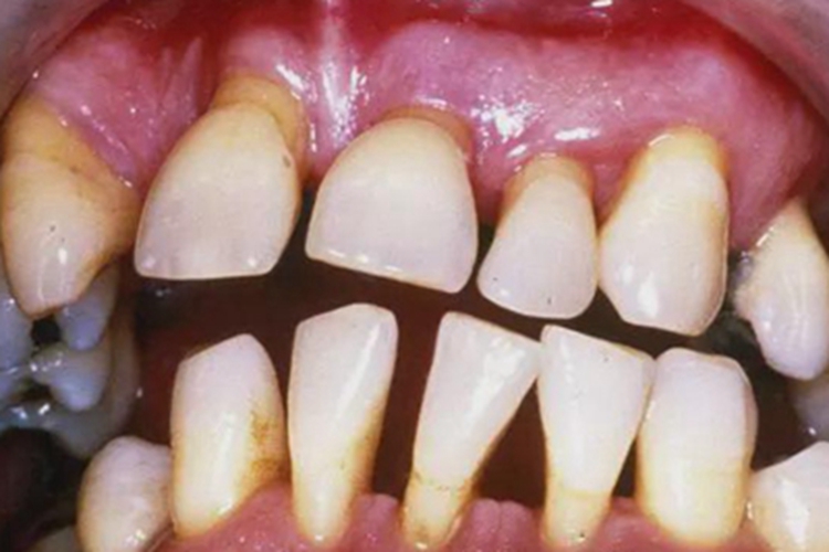 牙龈萎缩牙缝宽大牙齿变尖图 牙龈萎缩牙缝宽大牙齿变尖图