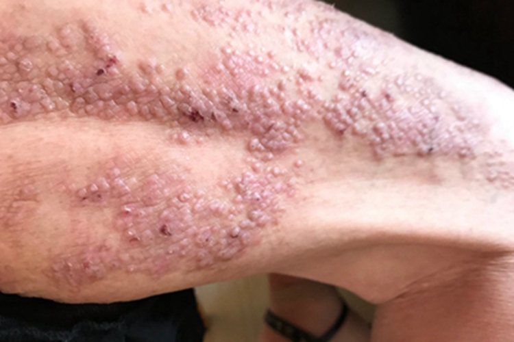 结节性痒疹大腿丘疹结痂图