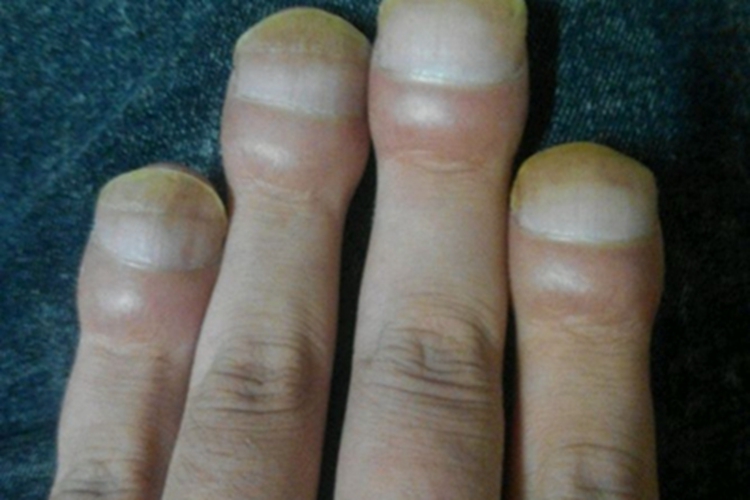 杵状指手指尖隆起图