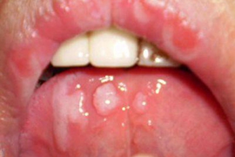 重型口疮舌头溃疡图 重型口疮舌头溃疡图