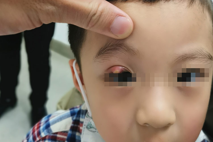儿童外麦粒肿图儿童内麦粒肿图原因儿童麦粒肿与眼睑外伤,金黄色葡萄