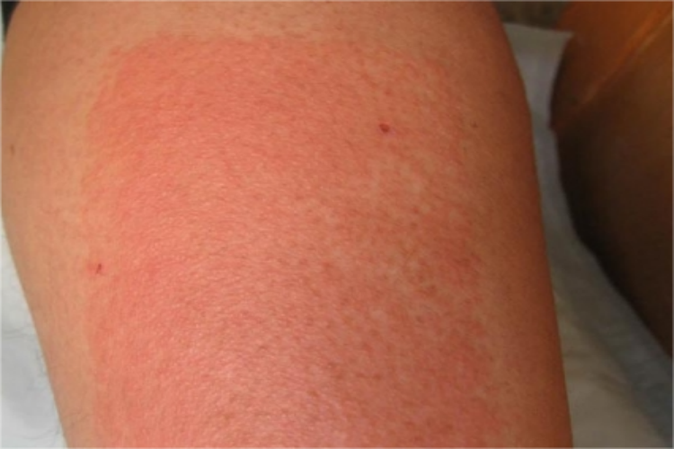 小腿急性接触性皮炎红斑图