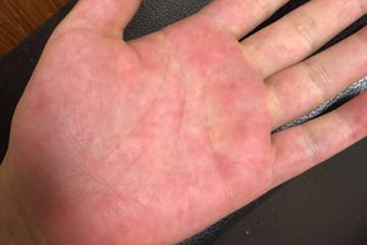 雷诺氏综合征皮肤潮红图