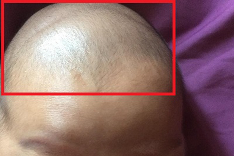 维生素A过多症头部症状图