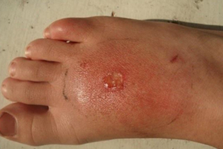 钩虫皮炎脚背出现水疱图