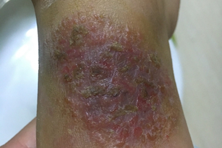 钱币状湿疹小腿溃疡图 钱币状湿疹小腿溃疡图