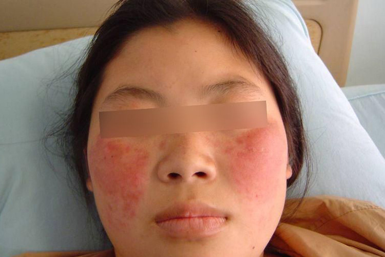 面部水肿性蝶形红斑图 面部水肿性蝶形红斑图