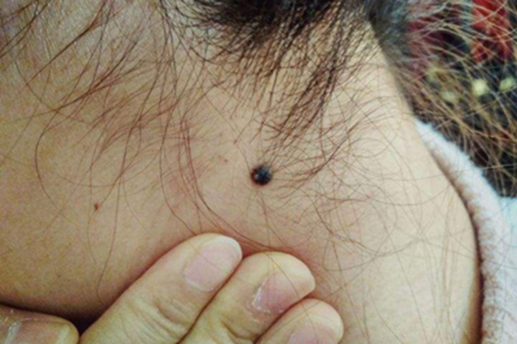 复合痣脖子侧面有黑痣图