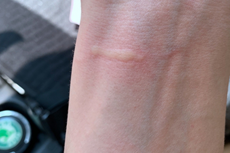 荨麻疹手腕风团图