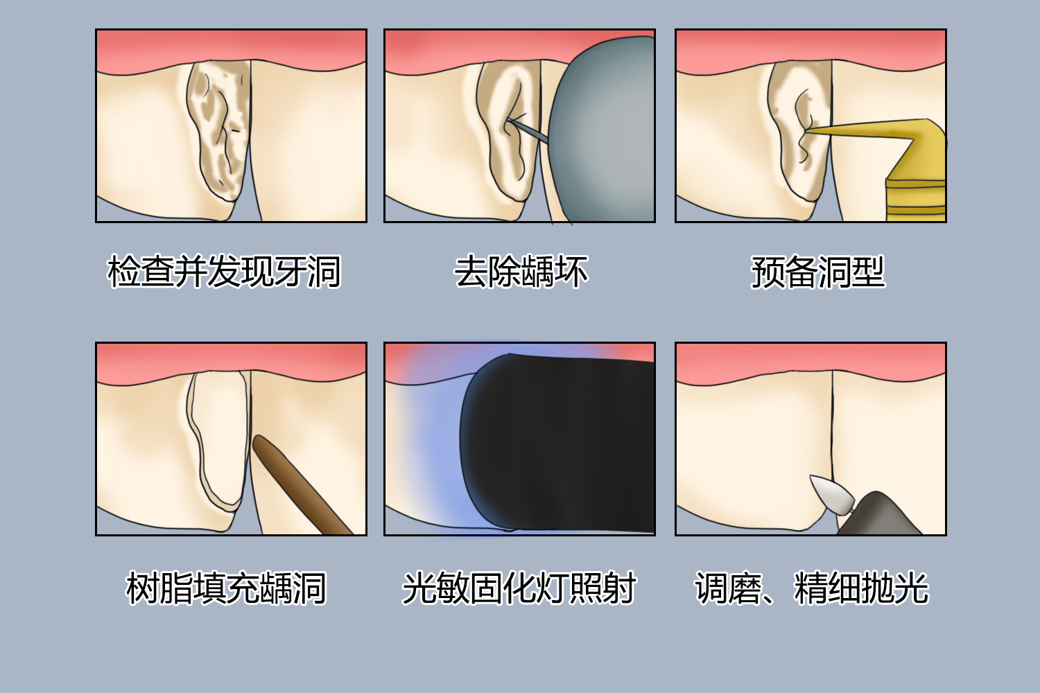 虫牙修补过程图