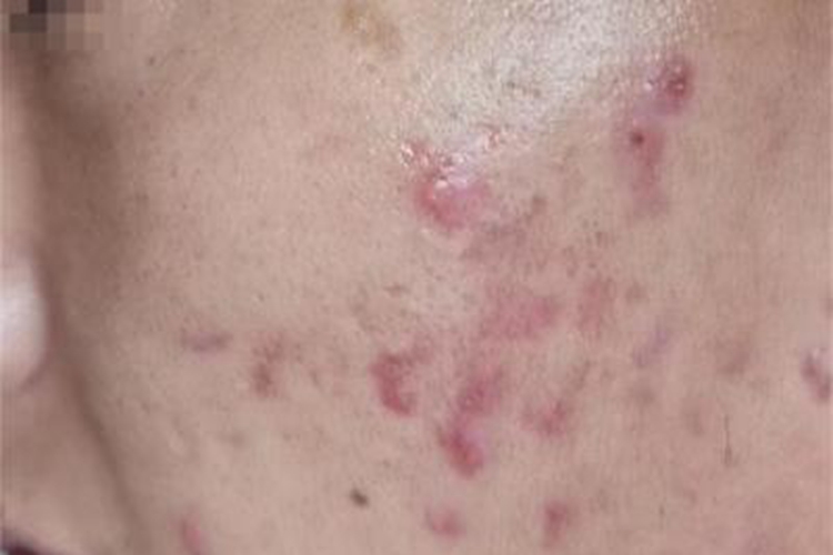 痤疮脸上很多红疙瘩图