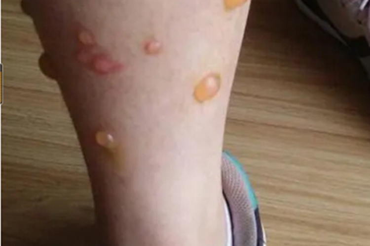 幼年型类天疱疮水疱图