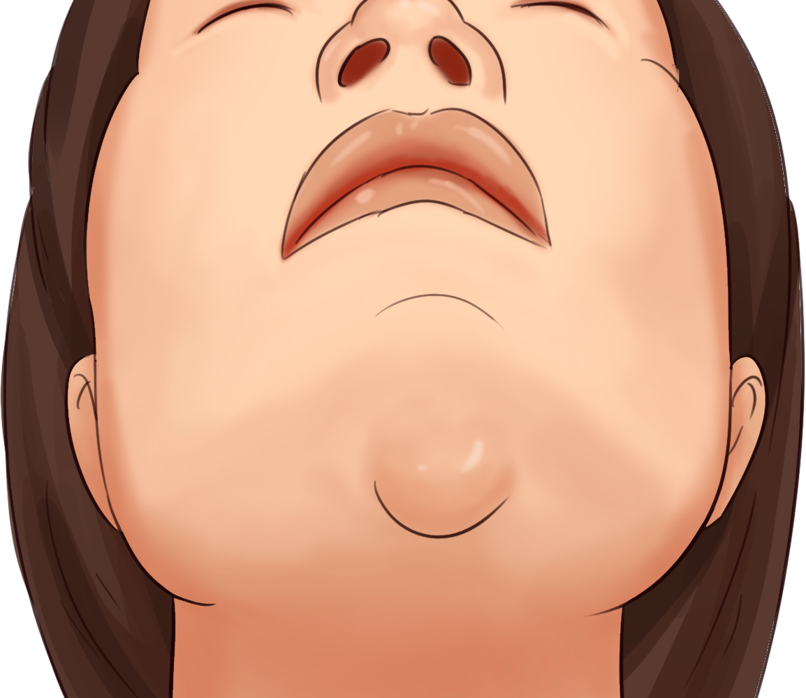 下巴颏下面皮样囊肿图