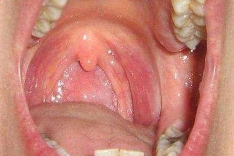 正常咽部图