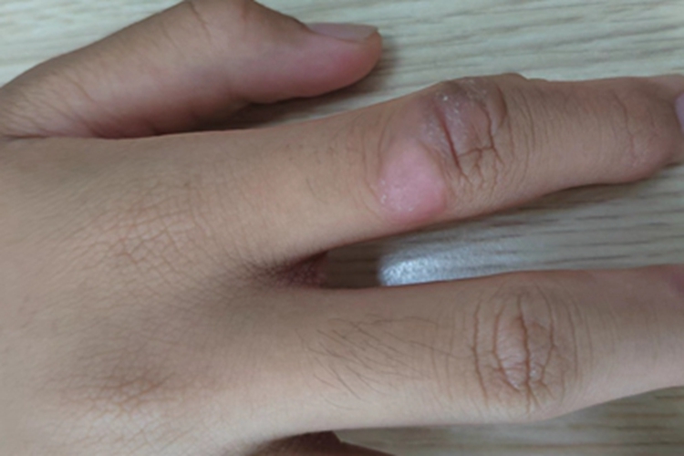 人工皮炎手指症状图