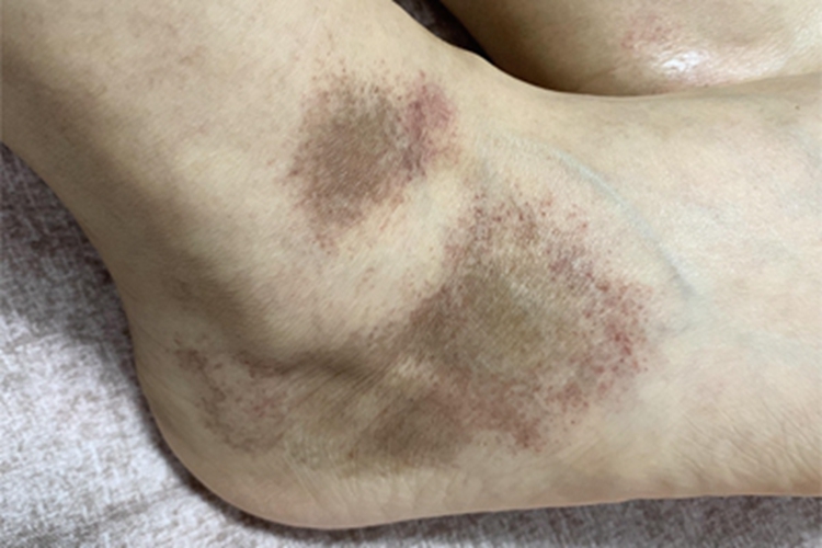 皮下出血脚踝症状图 皮下出血脚踝症状图