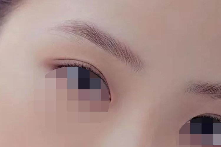 内低外高型双眼皮图