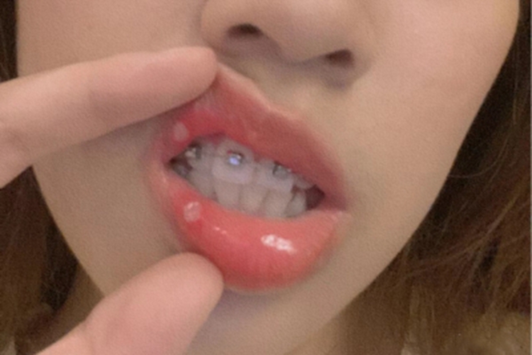 轻型复发性阿弗他口腔炎症状图