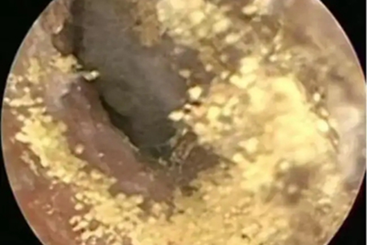 霉菌性外耳道炎耳朵有黄色颗粒图