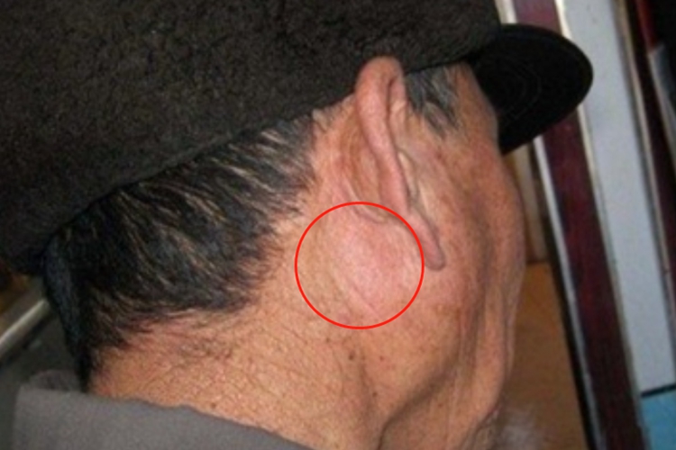 急性化脓性腮腺炎耳后症状图