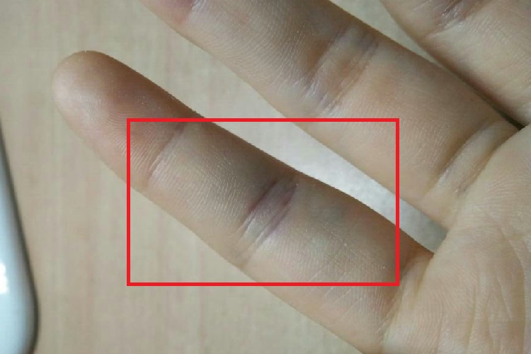 挫伤手指皮肤发黑图
