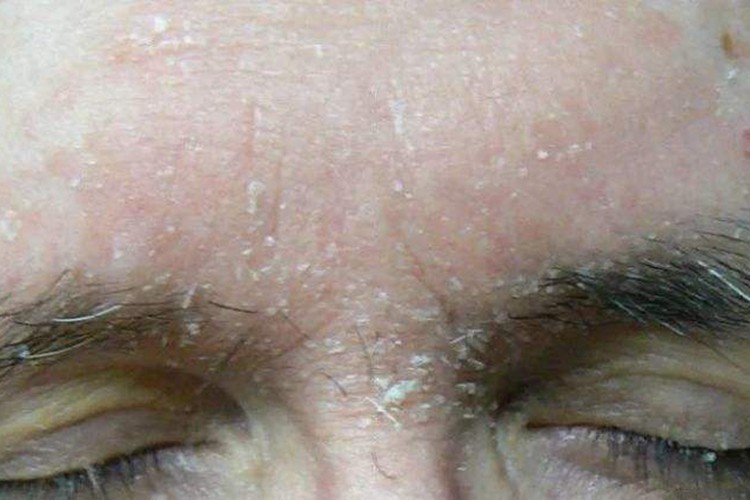 脂溢性皮炎白色皮屑图