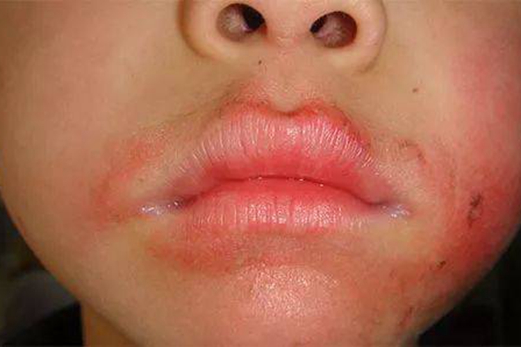 接触性皮炎嘴巴肿图
