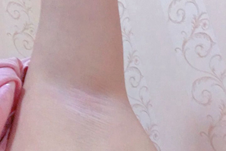 少毛症腋下没有毛图 少毛症腋下没有毛图