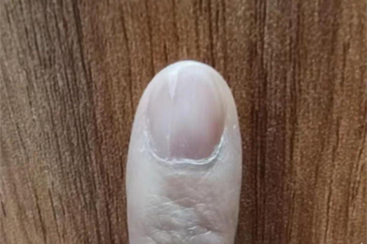 甲纵裂食指边缘裂开图