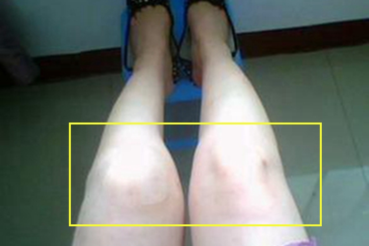 类风湿关节炎膝盖肿胀图