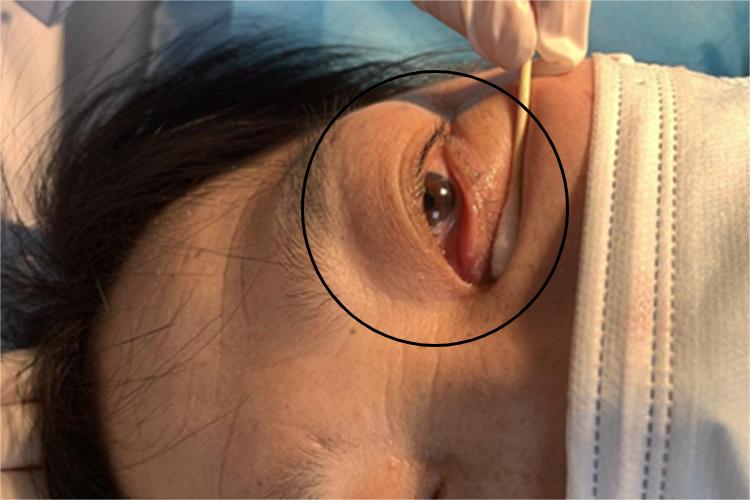 慢性泪囊炎肿图