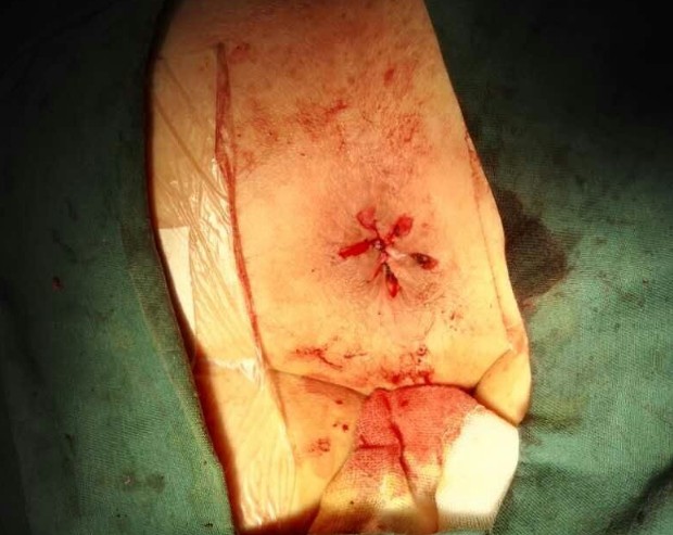 女性血栓性外痔图片图片
