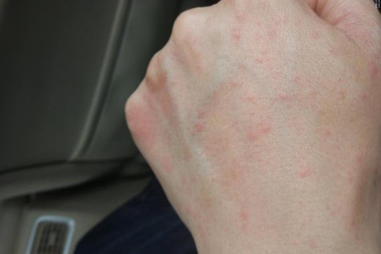 手背急性荨麻疹图 手背急性荨麻疹图