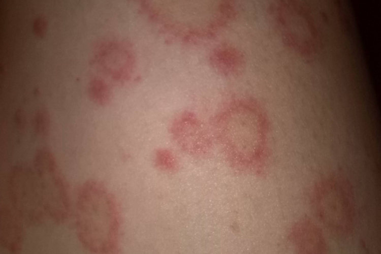 腿上体癣图 腿上体癣图