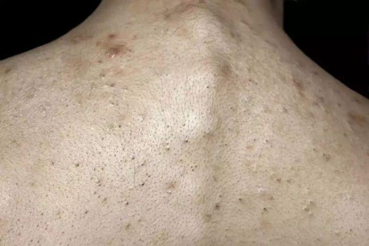 背上开放性粉刺图