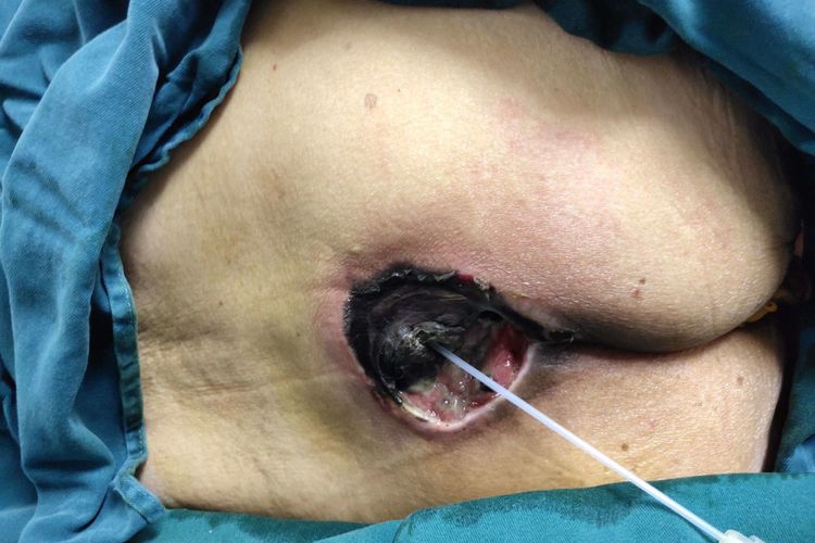 压疮臀部皮肤坏死图