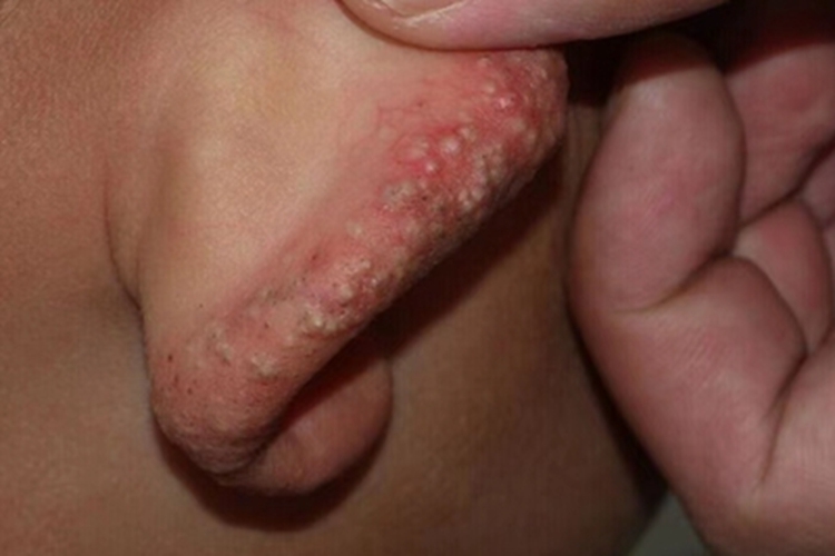 继发性粟丘疹耳部丘疹图